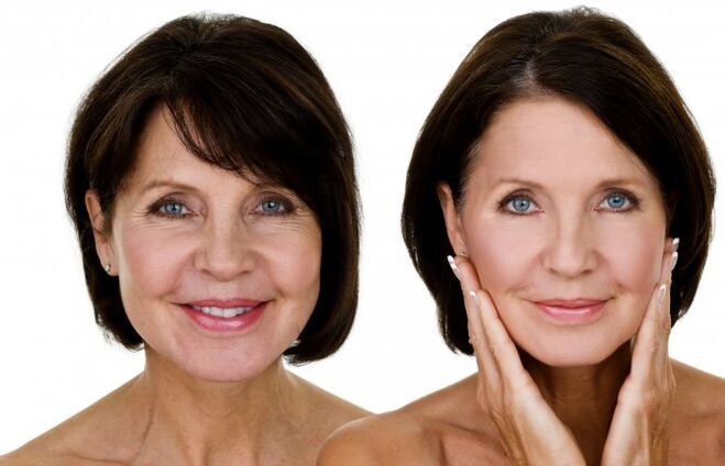 Before and after RF lifting