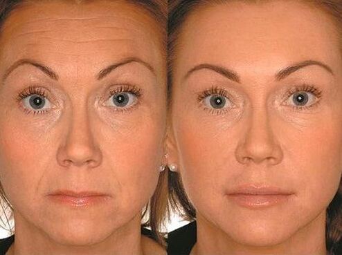 Before and after microcurrent therapy