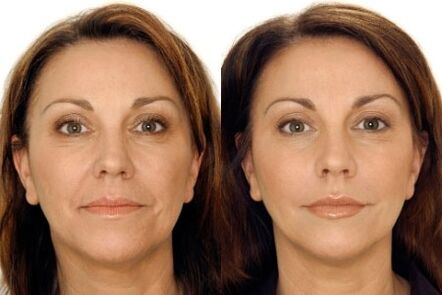 LPG massage of the face before and after