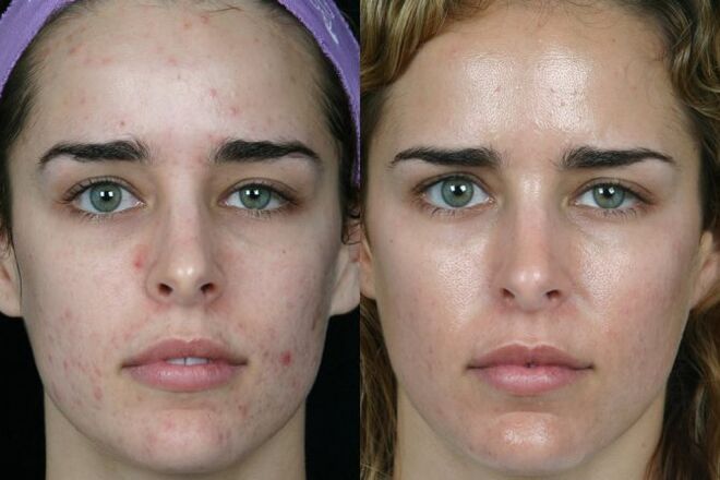 Laser grinding of the skin of the face before and after