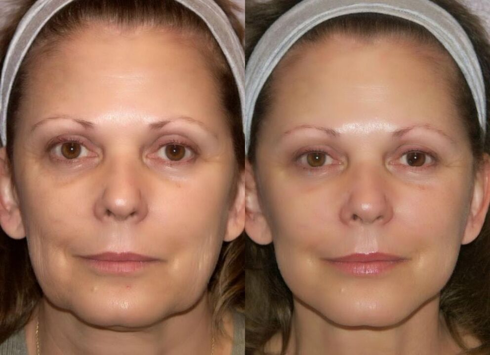 Face before and after hardware rejuvenation