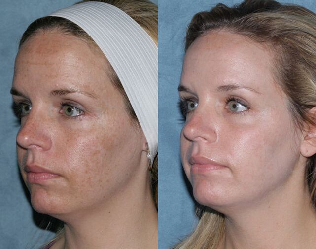 Photo before and after fractional rejuvenation of the face